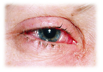 eye irritations relief