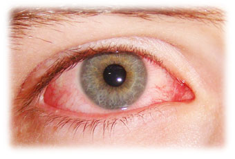 eye fatigue, ithcy eyes and red eyes relief