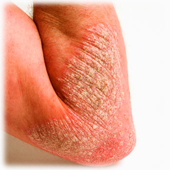 psoriasis relief with water therapy