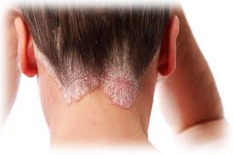 psoriasis relief