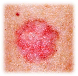 water therapy for skin spot with living water filter