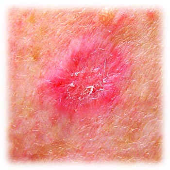 skin spots treatment with water therapy applied with living water filter