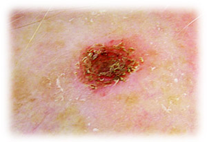 unhealthy skin spot relief by using water therapy and living water filter